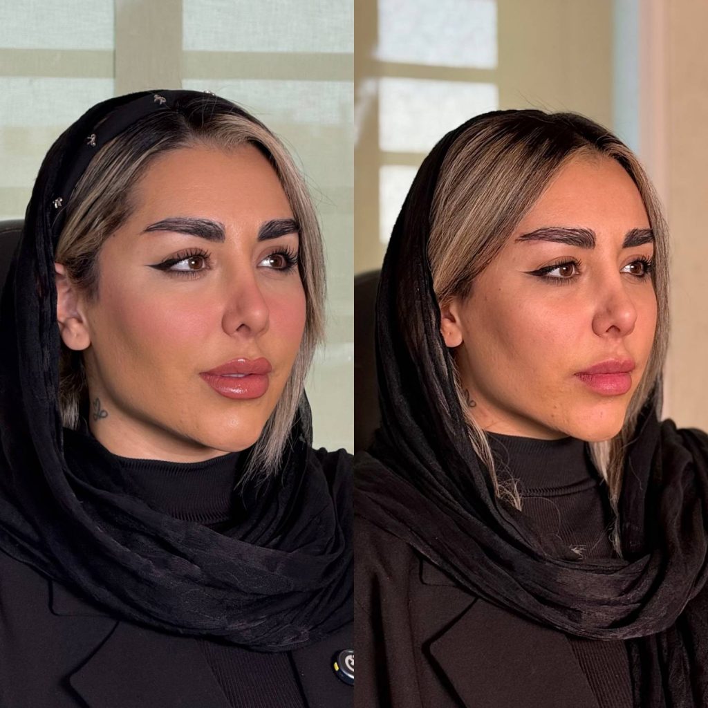 نمونه کار بایوفیلر دکتر حسینی