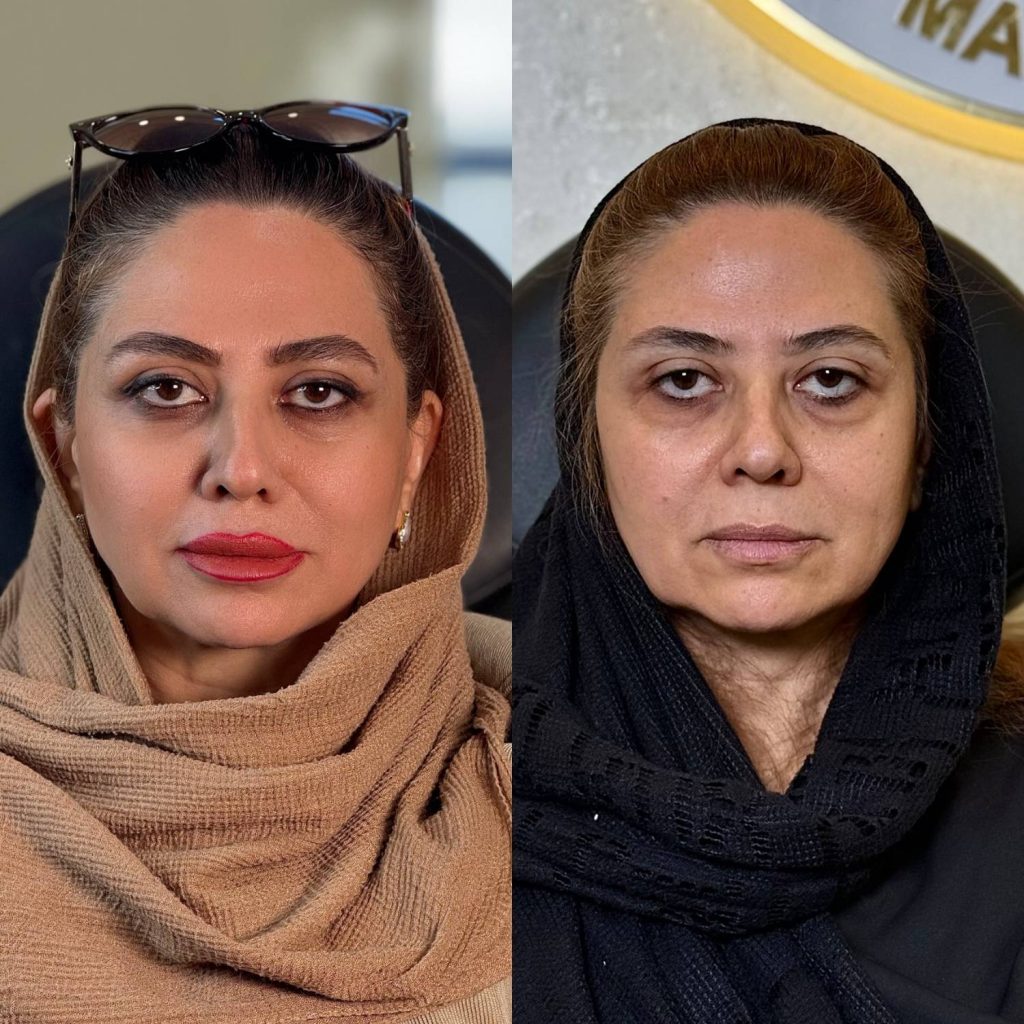 نمونه کار بایوفیلر دکتر حسینی