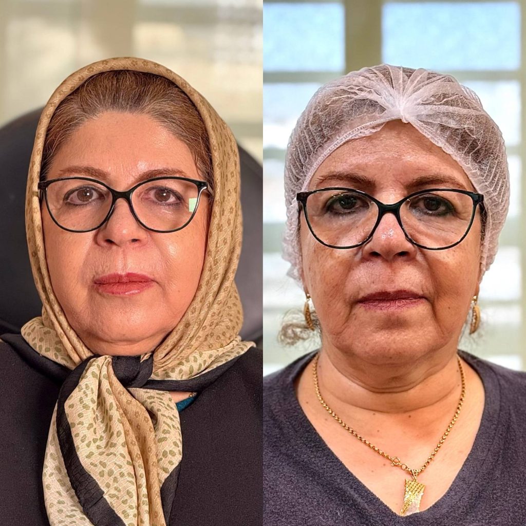 لیفت با نخ نمونه کار دکتر الهه حسنی اراک