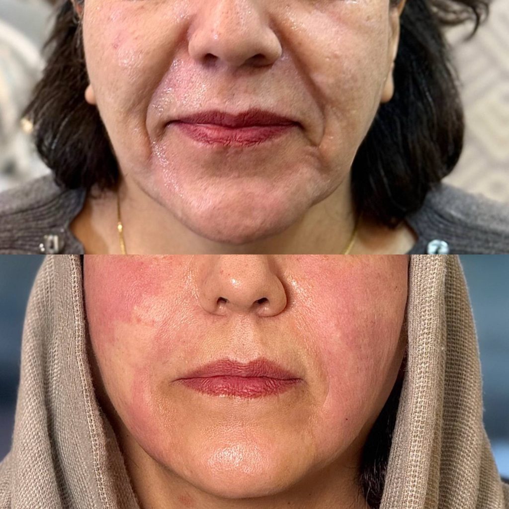 لیفت با نخ نمونه کار دکتر الهه حسنی اراک