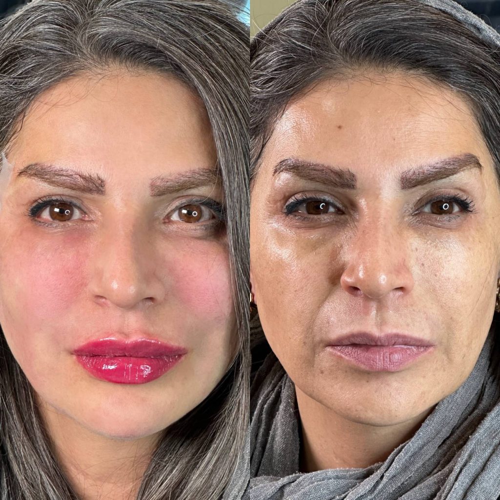 لیفت با نخ نمونه کار دکتر الهه حسنی اراک