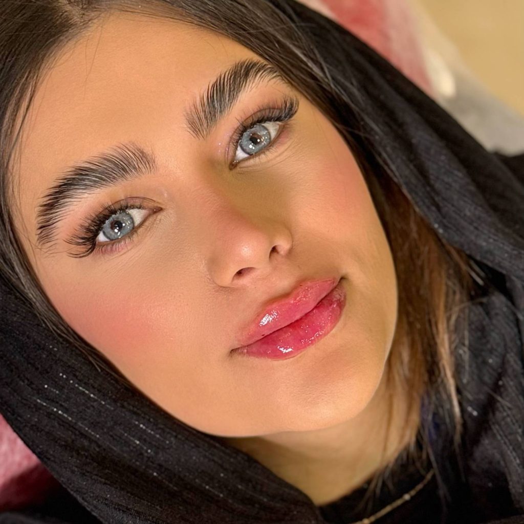 نمونه کار تزریق ژل لب