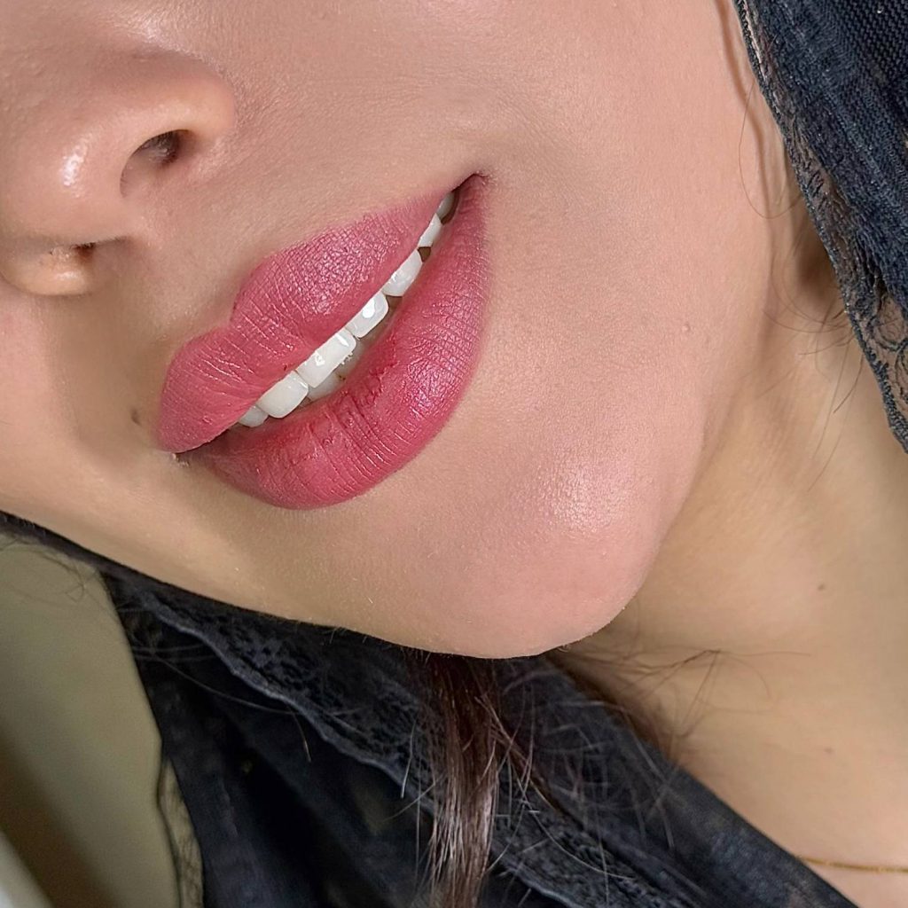 نمونه کار تزریق ژل لب